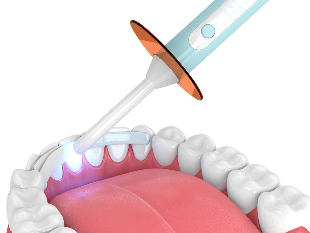 illustration of a device used for dental bonding
