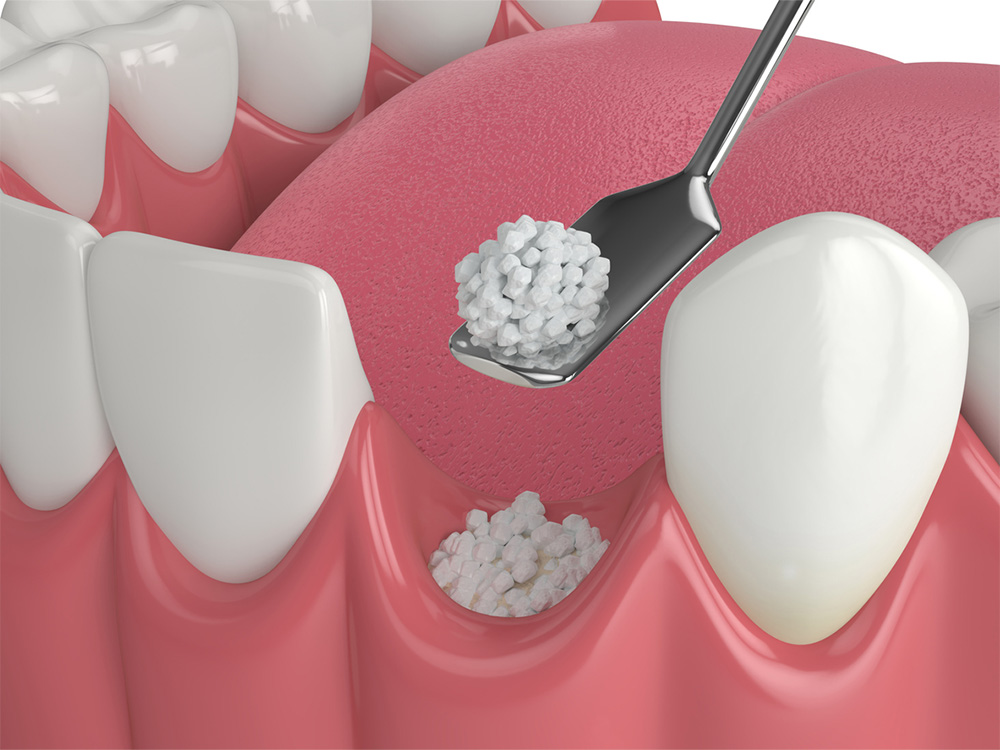 illustration showing the dental bone grafting process
