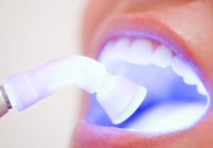 soft tissue laser being used in a patient's mouth