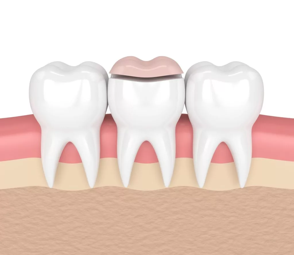illustration of a dental inlay and only