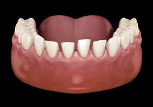illustration of spaced out teeth