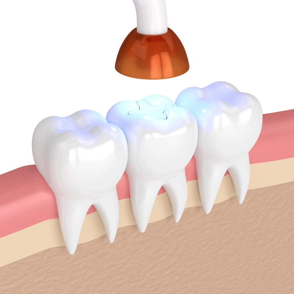 illustration of a filling and sealant