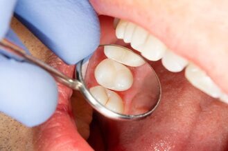 Close‑up of open mouth with gloved hand holding dental mirror reflecting molar teeth and gums during examination.